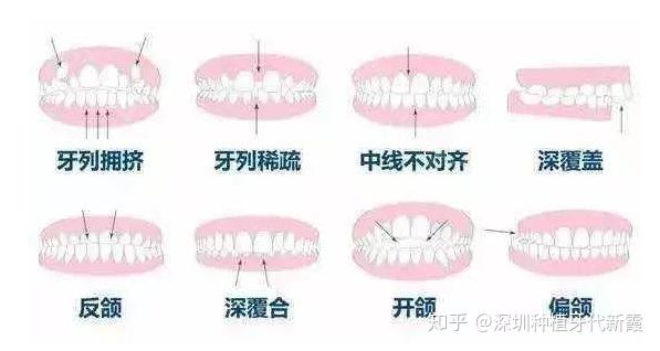 最新科技牙套，重塑牙齿美观与健康的未来之选